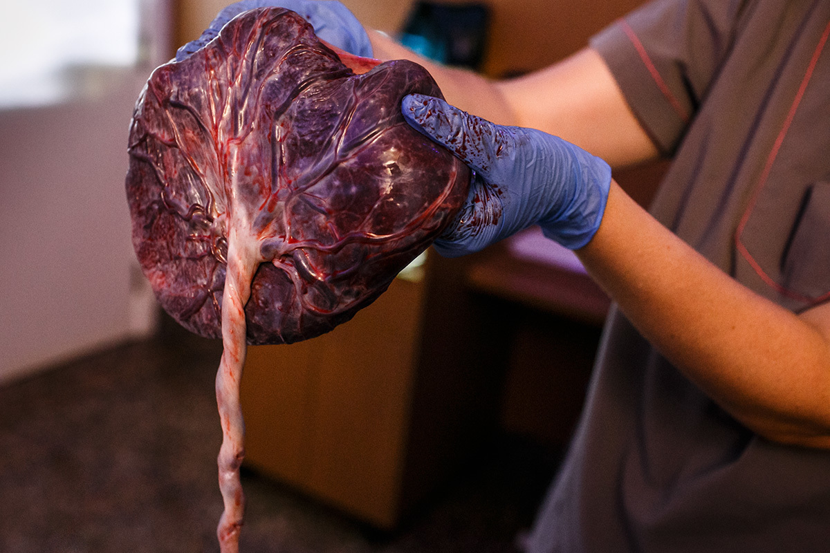 placenta após parto normal