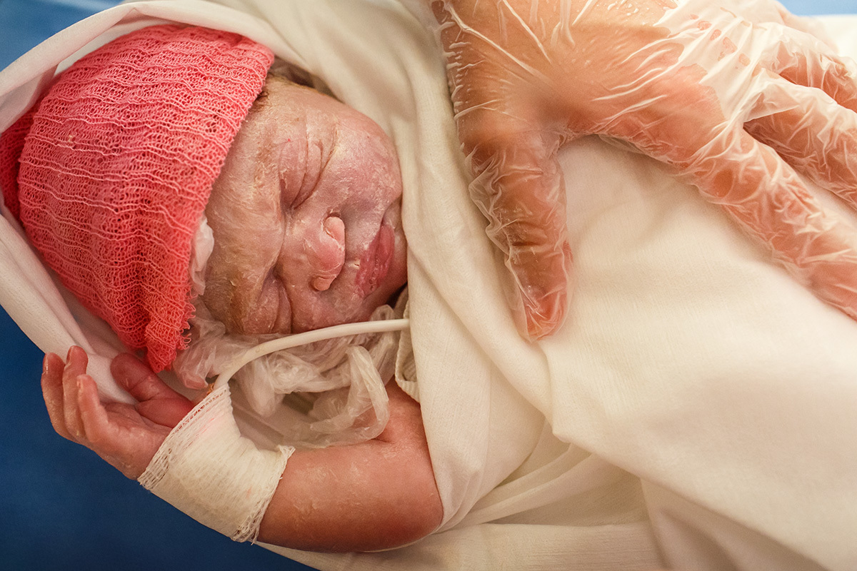 bebê prematuro é enrolado para manter sua temperatura corporal