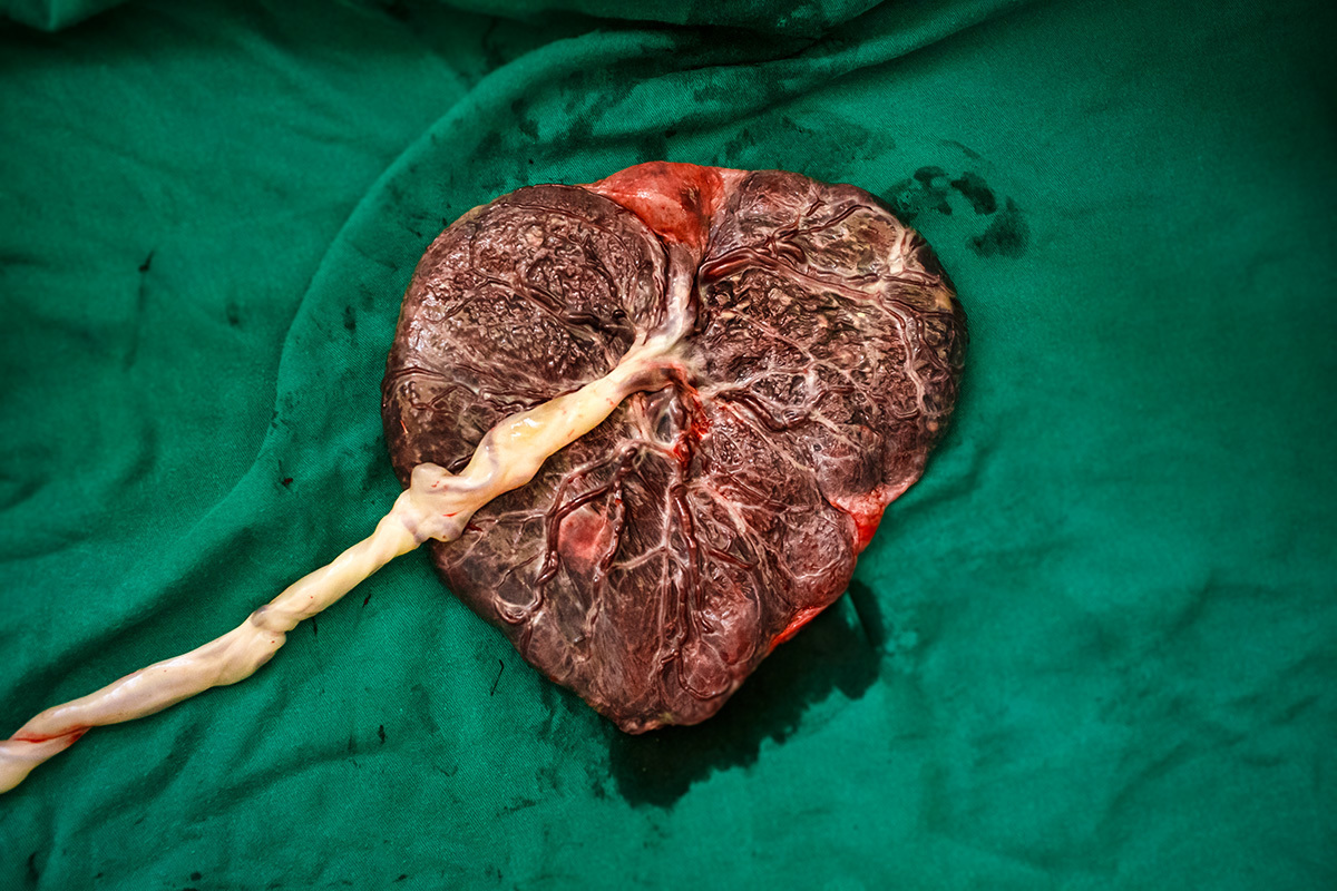 placenta em forma de coração