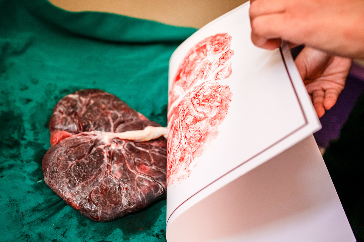 print da placenta em forma de coração