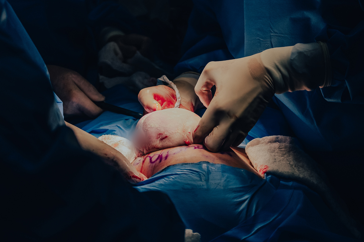 Parto pélvico, Parto maternidade perinatal, Fotografa de parto rio de janeiro, fotografo de parto, parto cesárea, parto, nascimento, foto, fotografia, rio de janeiro, rj, li marques fotografia