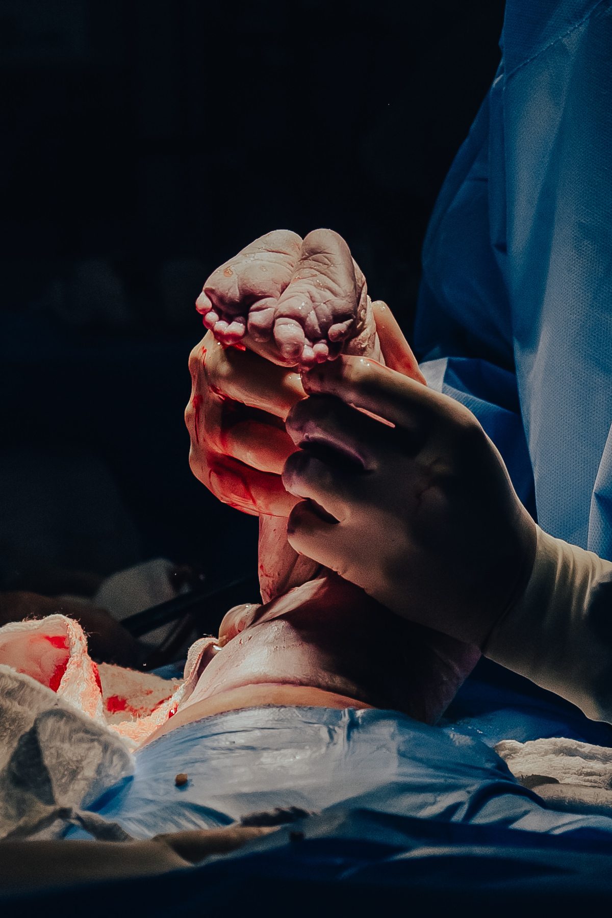 Parto pélvico, Parto maternidade perinatal, Fotografa de parto rio de janeiro, fotografo de parto, parto cesárea, parto, nascimento, foto, fotografia, rio de janeiro, rj, li marques fotografia