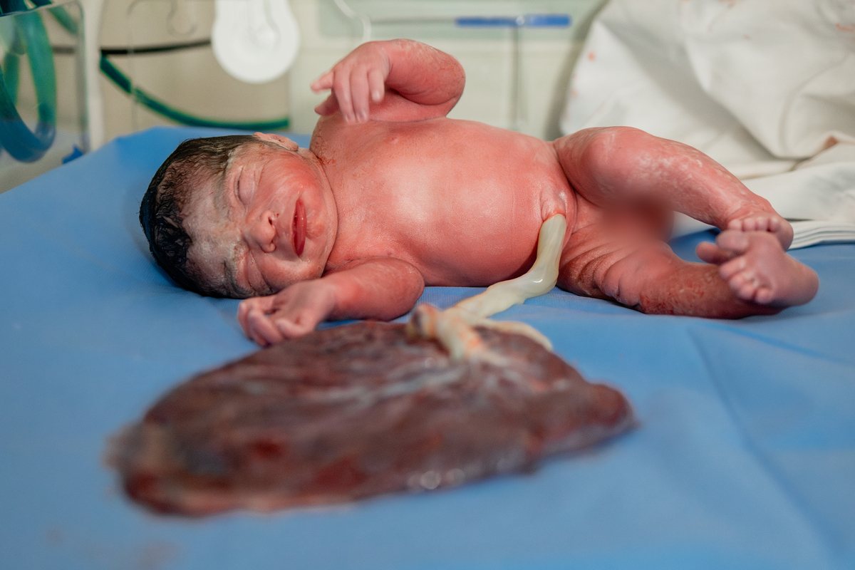 Parto maternidade Santa Lúcia, Fotografa de parto rio de janeiro, fotografo de parto, parto normal, Parto natural, parto humanizado, parto, nascimento, foto, fotografia, rio de janeiro, rj, li marques fotografia, placenta, cordão umbilical curto