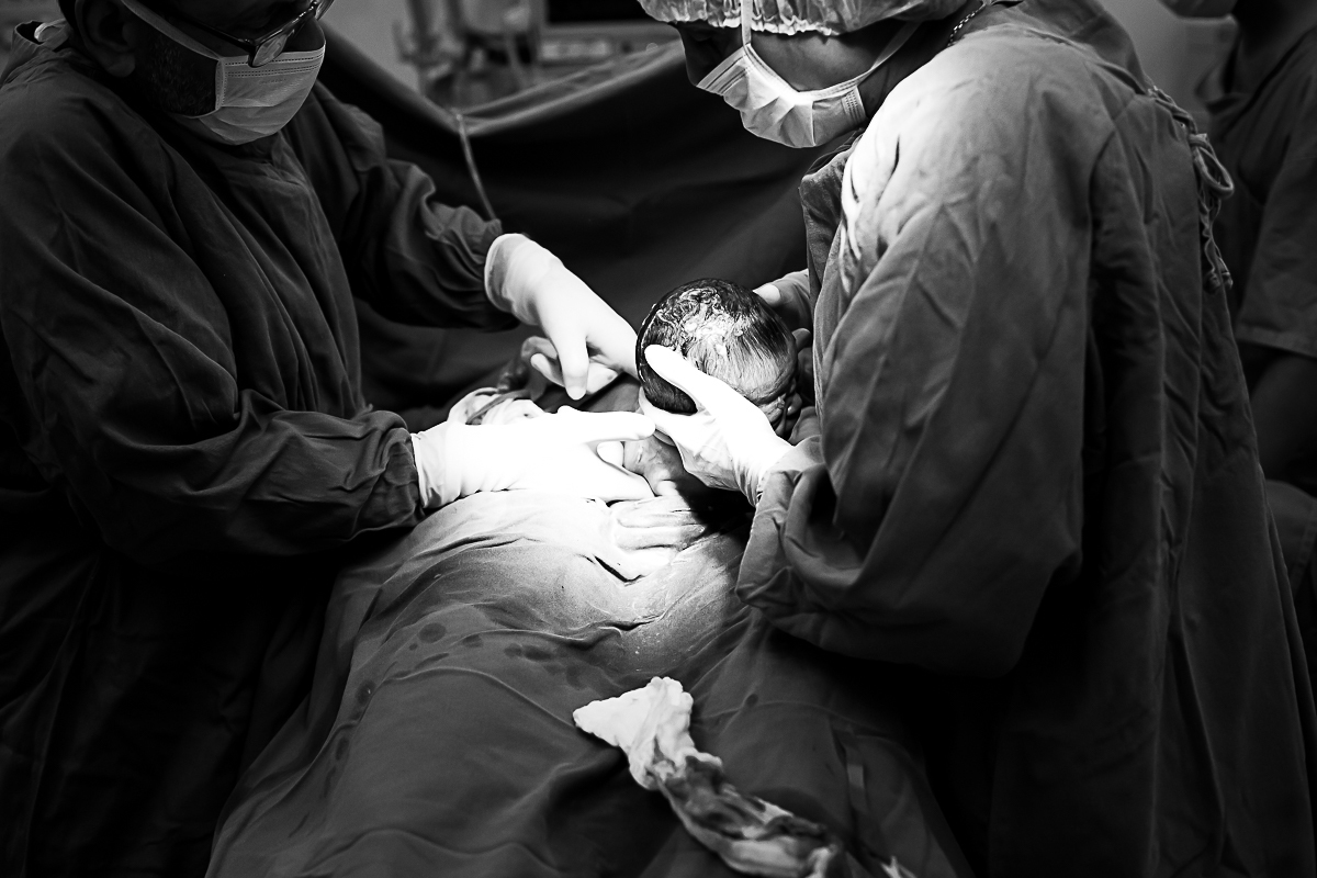 Parto cesariana no momento em que o bebê está nascendo.