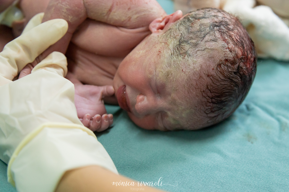 Momento em que a Ana Luísa  nasce! Fotografo de parto Mônica Rivaroli fotografia em Maringá. Tentantes, infertilidade, trombofilia endometriose.  Já foi cortado o cordão umbilical.Parto de gêmeos, gestação gemelar. 
