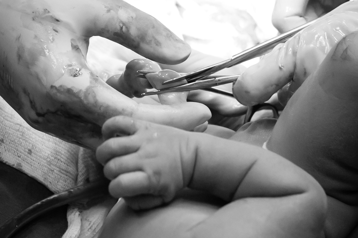 médico cortando o cordão umbilical