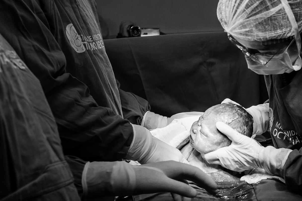 bebê sendo retirado da barriga mãe