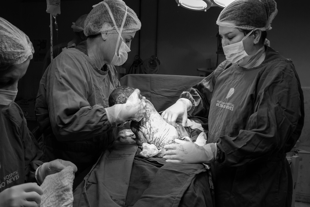 bebê saindo da barriga da mãe