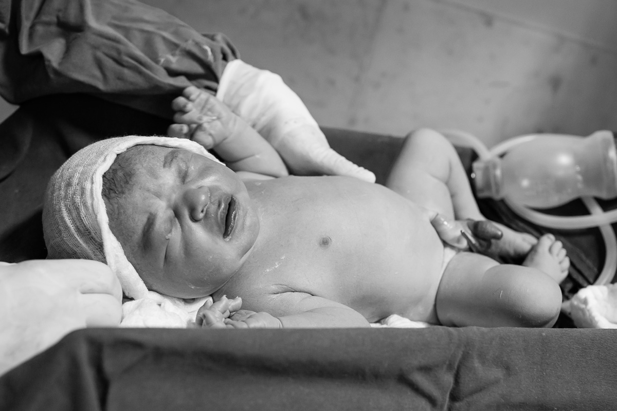 bebê com gaze na cabeça