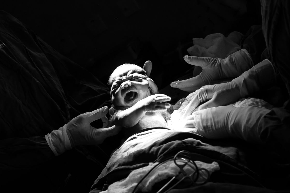 bebê nascendo de cesárea