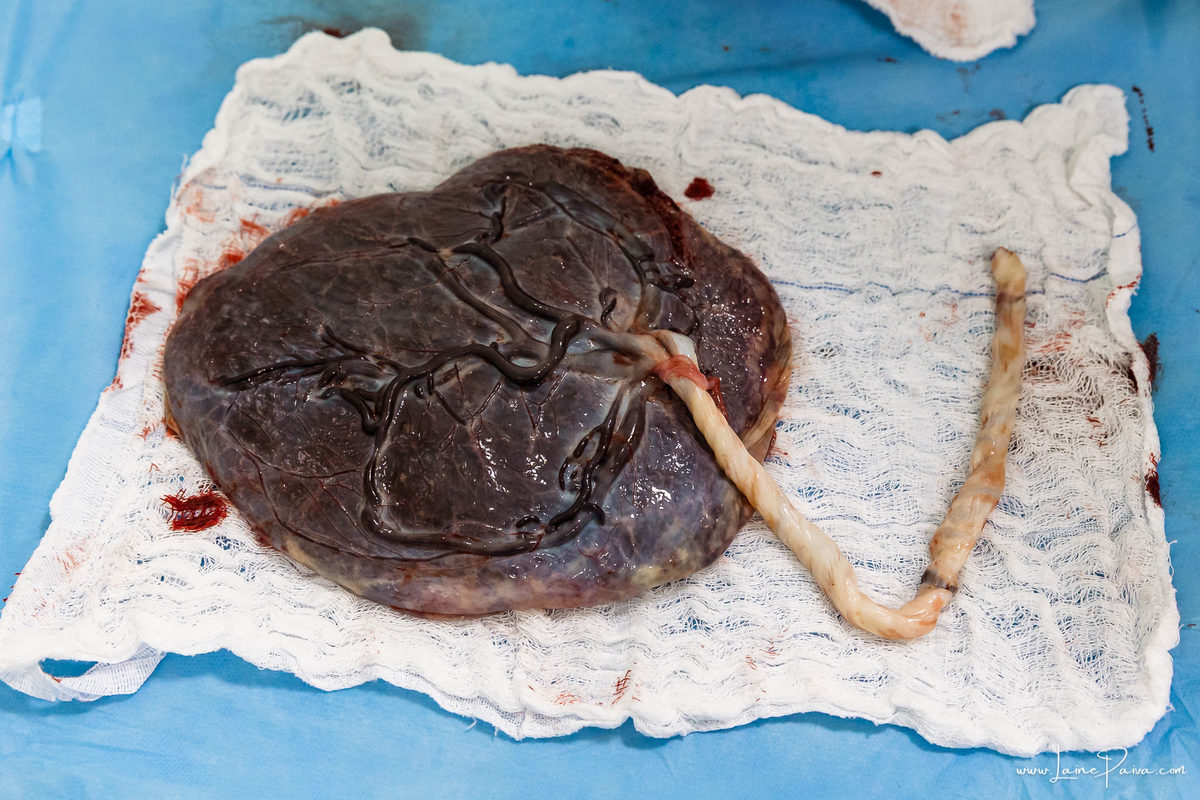 fotografia de parto na maternidade do hospital do coração,  parto cesaria, mãe de primeira viagem de menino, primeiros momentos de vida com amor e cuidado, fotografo de parto e familia em Natal, cobertura completa da cesariana