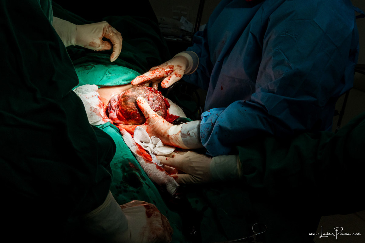 fotografia de parto na maternidade do hospital rio grande, maternidade Delphin,  parto cesaria, mãe de pimeira viagem de menina, primeiros momentos de vida com amor e cuidado, fotografo de parto e familia em Natal, cobertura completa da cesariana,