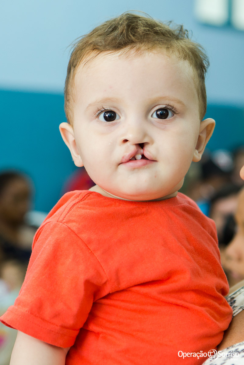 criança fissura na triagem para cirurgia da operação sorriso