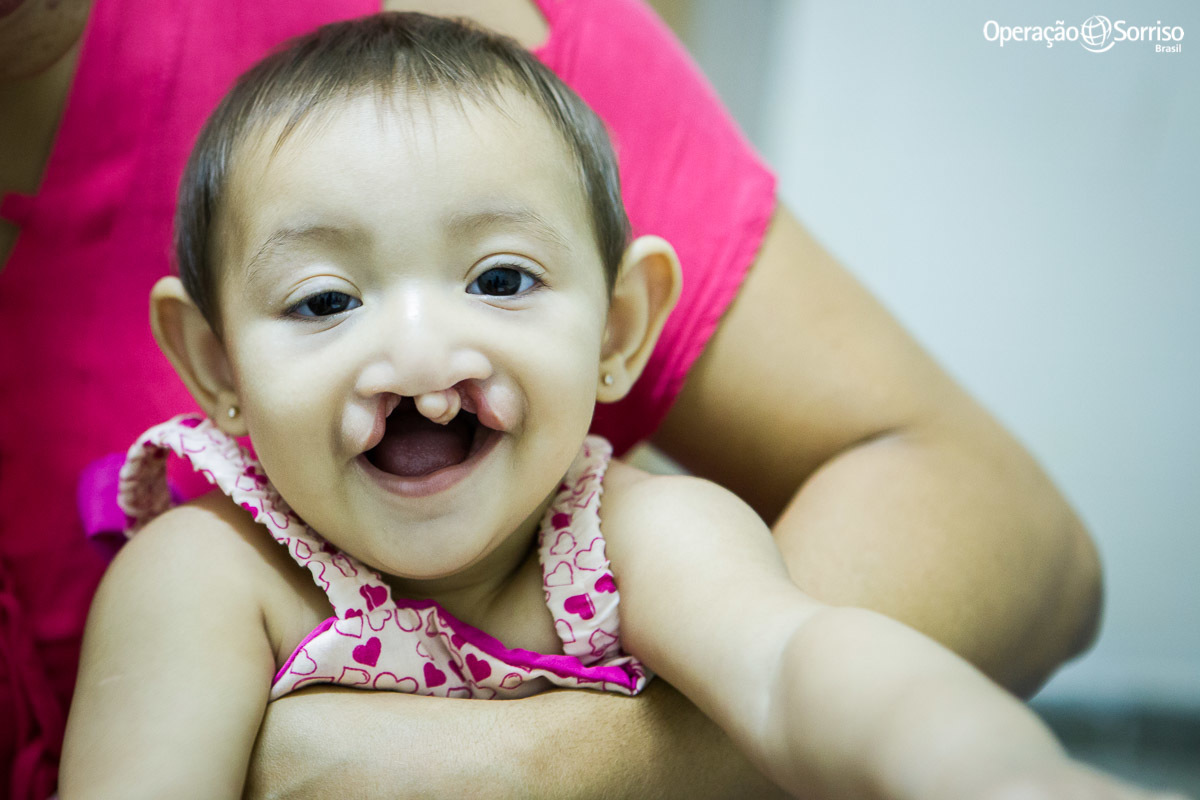 criança com fissura na triagem para cirurgia da operação sorriso