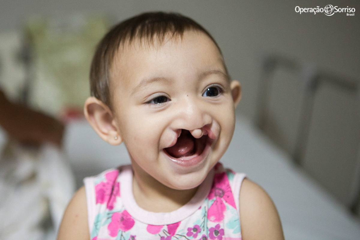 criança fissurada sorrindo