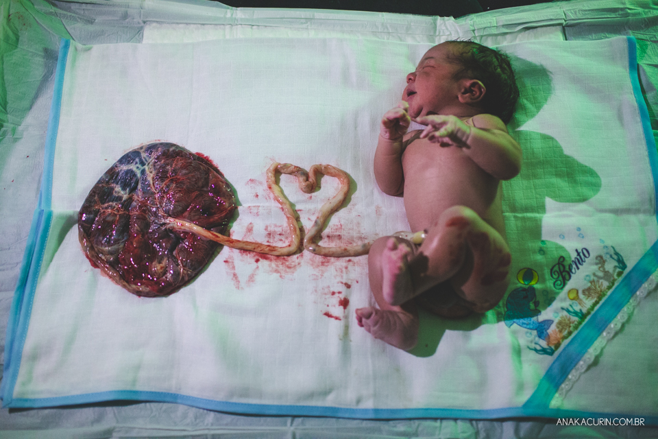 bebê recém nascido ainda conectado À pacenta através do cordão umbilical, que faz um formato de coração