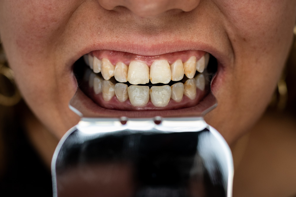 Dentes antes do tratamento