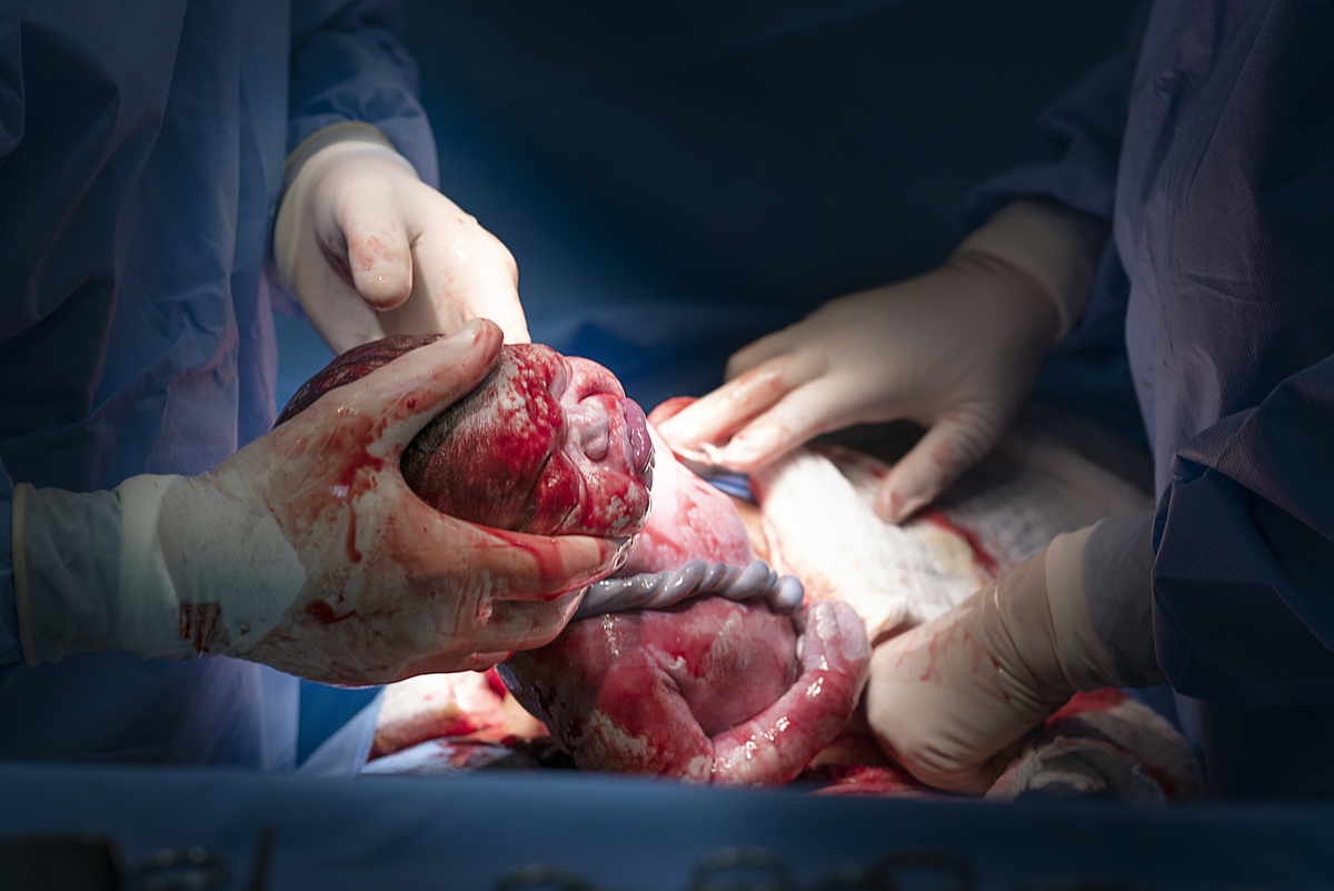 fotografia de nascimento, parto, cesaria, cesariana, nascimento, tania bauer fotografia, fotografia de parto, 