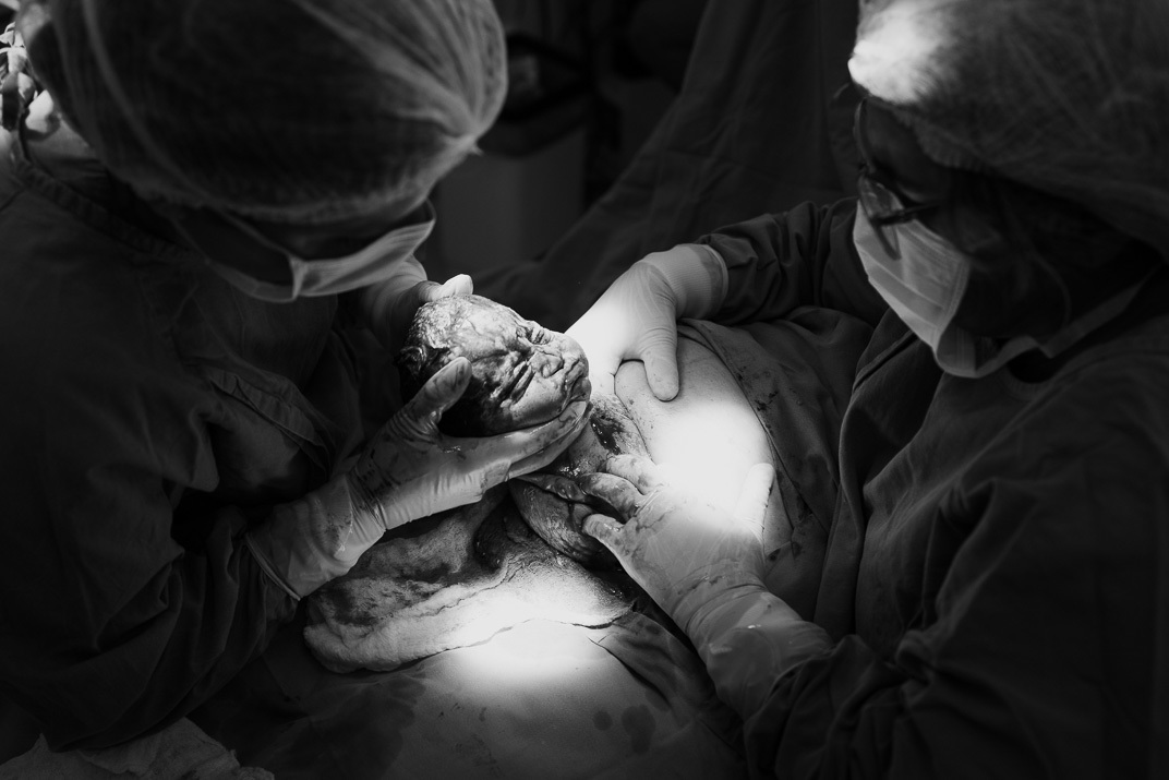 Bebê é acolhido pelas mãos da equipe médica durante o nascimento no Hospital Bruno Born, em Lajeado – registro do Alba Estúdio.