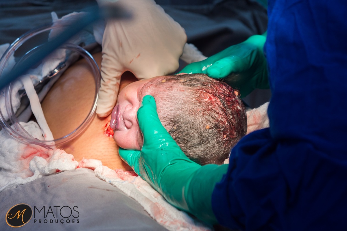 Fotografia Documental de Parto em Santos - Hospital Ana Costa