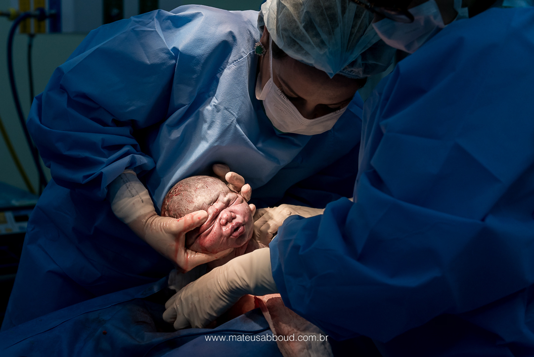 Obstetra segurando o bebê pela cabeça e retirando ele da barriga da mãe.