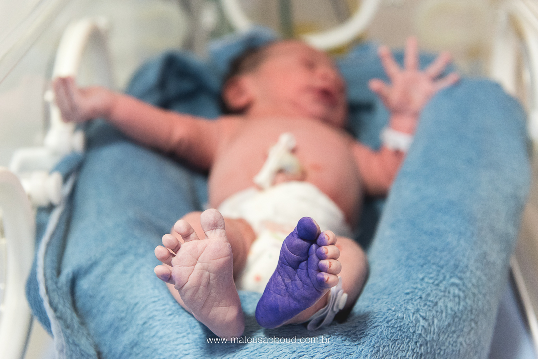 foto dos pés do bebê na encubadora, um dos pés está com a tinha roxa