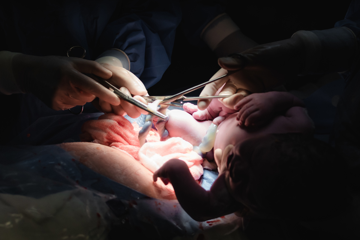 foto de aprto em natal rn - o corte do cordão umbilical