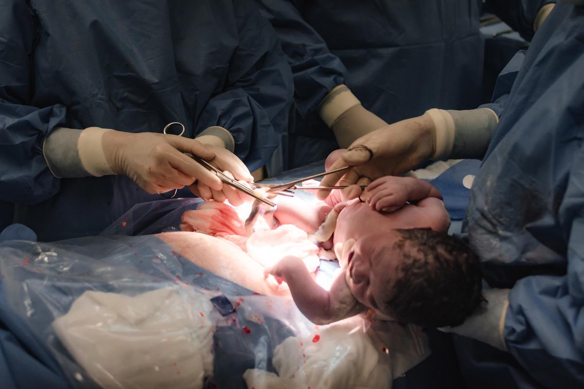 foto de aprto em natal rn - o corte do cordão umbilical