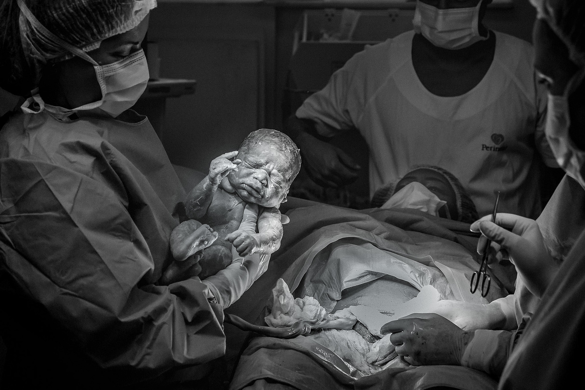 foto preto e branco de bebe ao sair da barriga da mae em cesariana