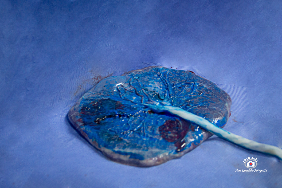 Fotografia do nascimento do Derick Kayodê no Domingos Lourenço Hospital e  Maternidade. 