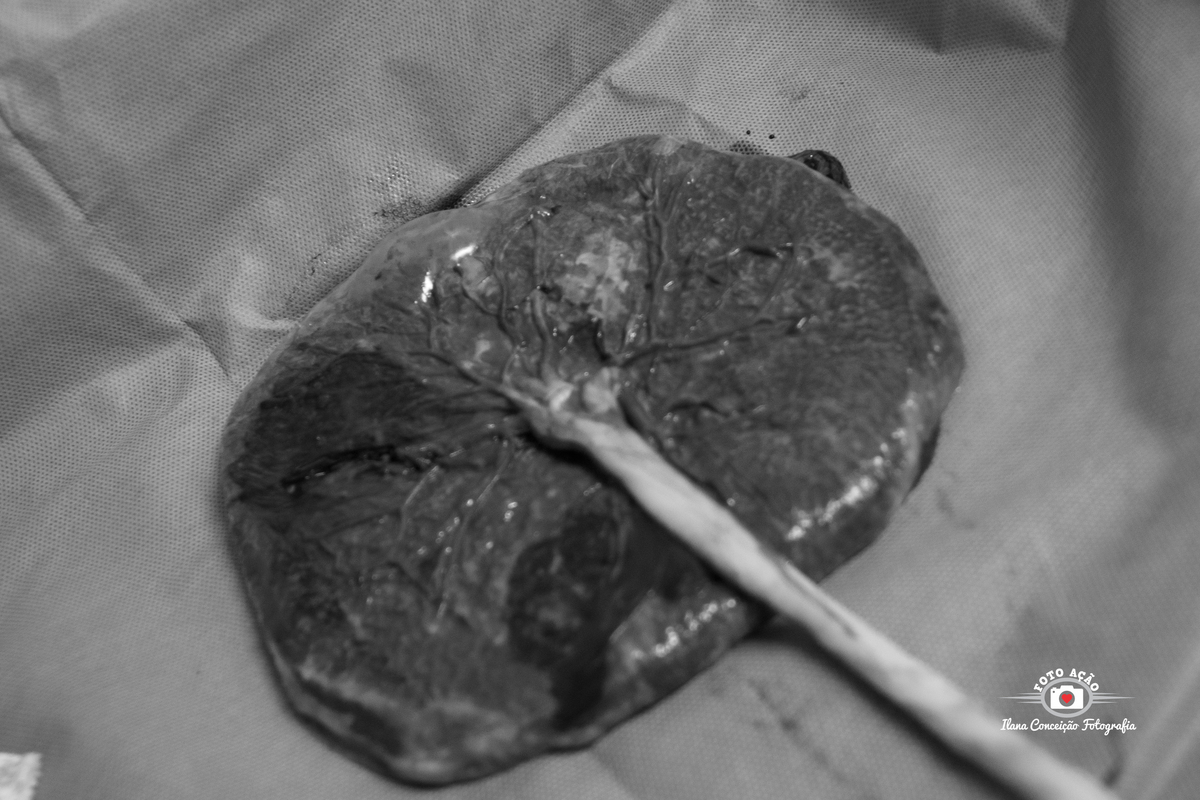 Fotografia do nascimento do Derick Kayodê no Domingos Lourenço Hospital e  Maternidade. 