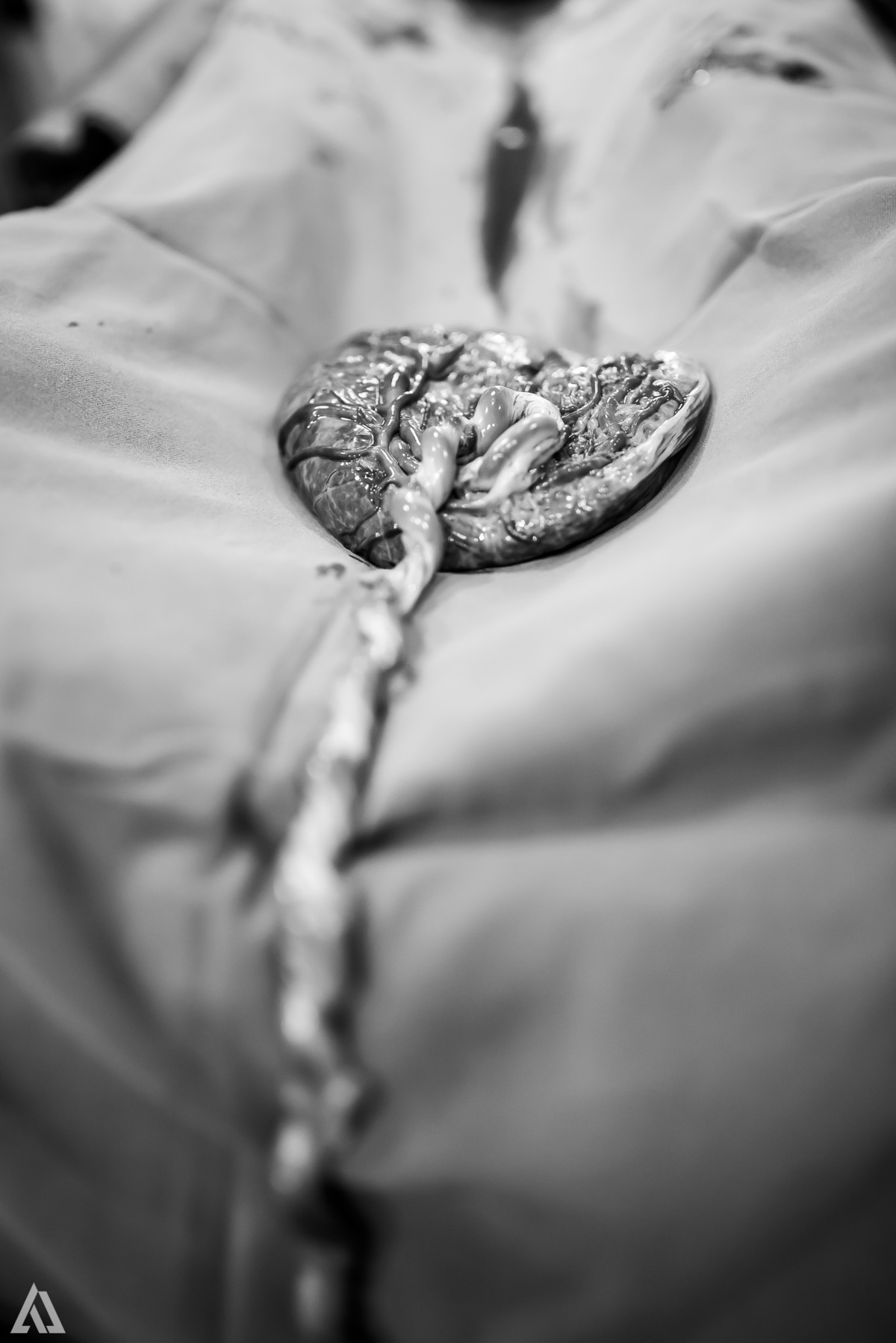 Fotografia de Parto Cesárea Normal Humanizado Alex Jardim Fotografia Fotógrafo iapbp cesarean maternidade Resende Itatiaia Penedo Porto Real Quatis Barra Mansa Volta Redonda Serrinha do Alambari Hospital Maternidade APMIR SAMER UNIMED