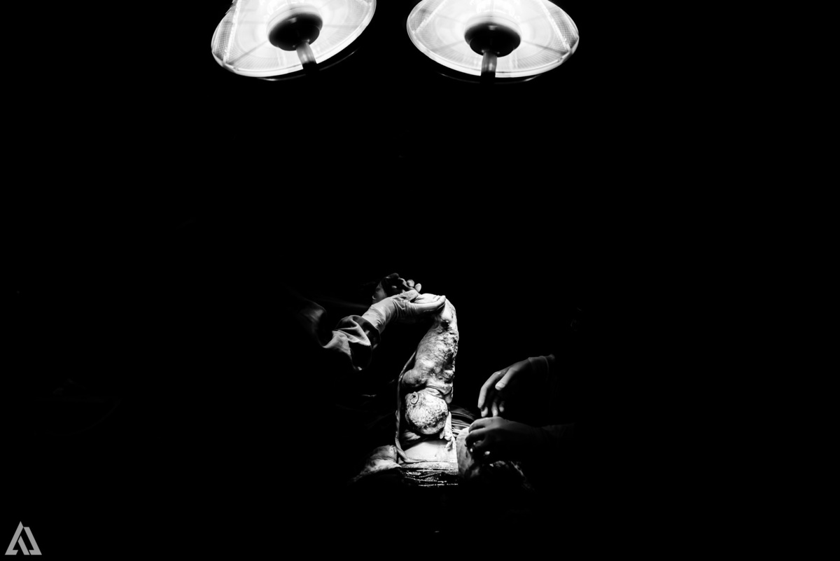 Fotografia de Parto Cesárea Normal Humanizado Alex Jardim Fotografia Fotógrafo iapbp cesarean maternidade Resende Itatiaia Penedo Porto Real Quatis Barra Mansa Volta Redonda Serrinha do Alambari Hospital Maternidade APMIR SAMER UNIMED