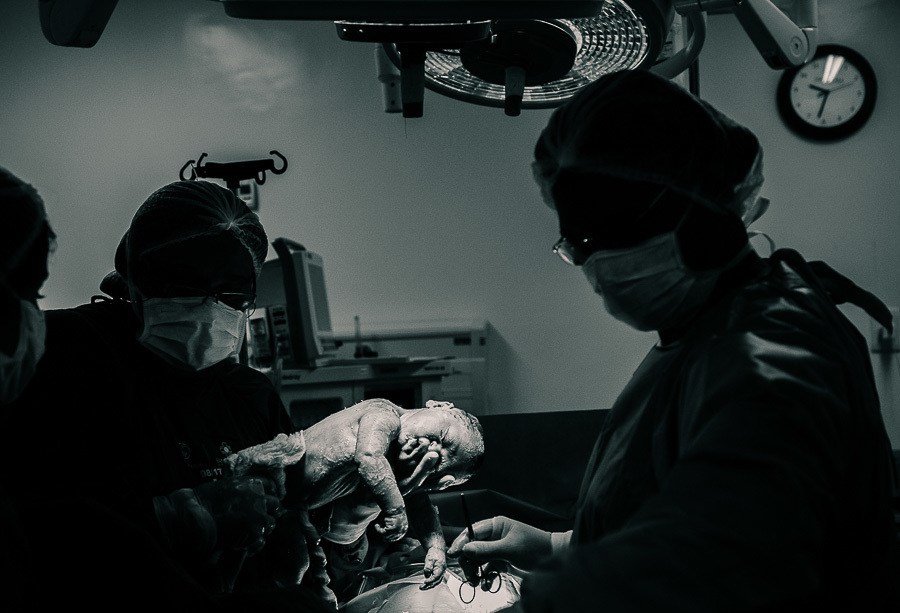 bebê saindo da barriga da mãe