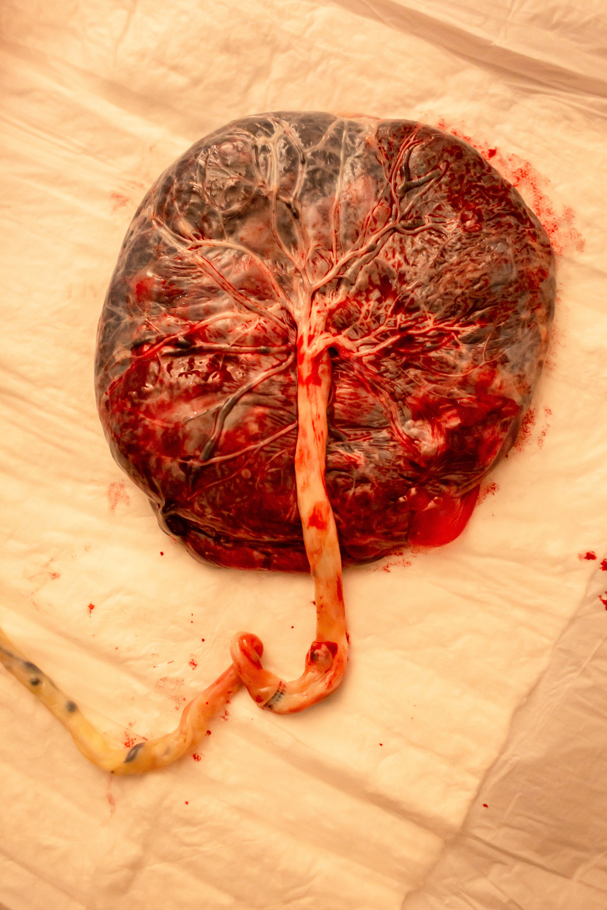 placenta
