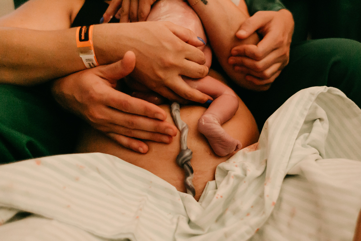 nó verdadeiro de cordão parto na unimed chapecó
