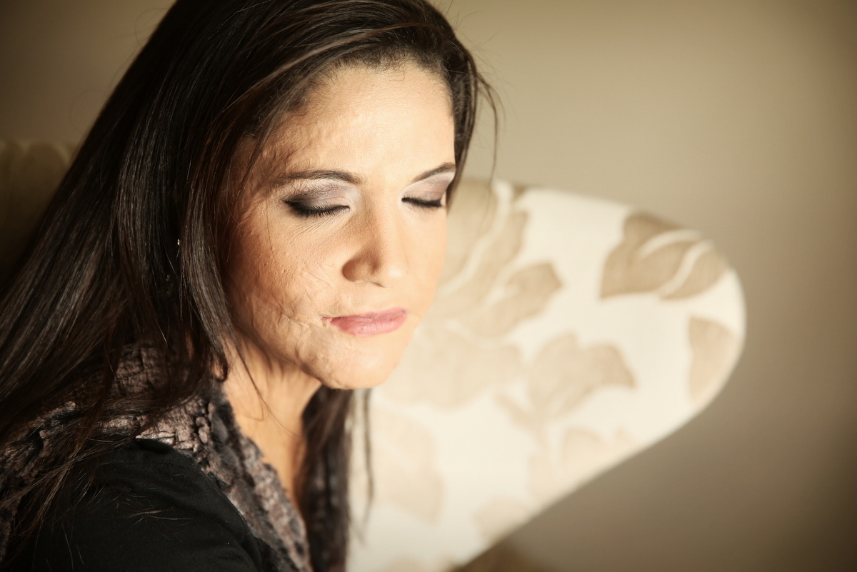 Ivna sá, ivna sá para mulheres, mulher queimada, ensaio feminino em belo horizonte, palestra para mulheres, queimadura, ivna sá fotografia, estúdio em belo horizonte 