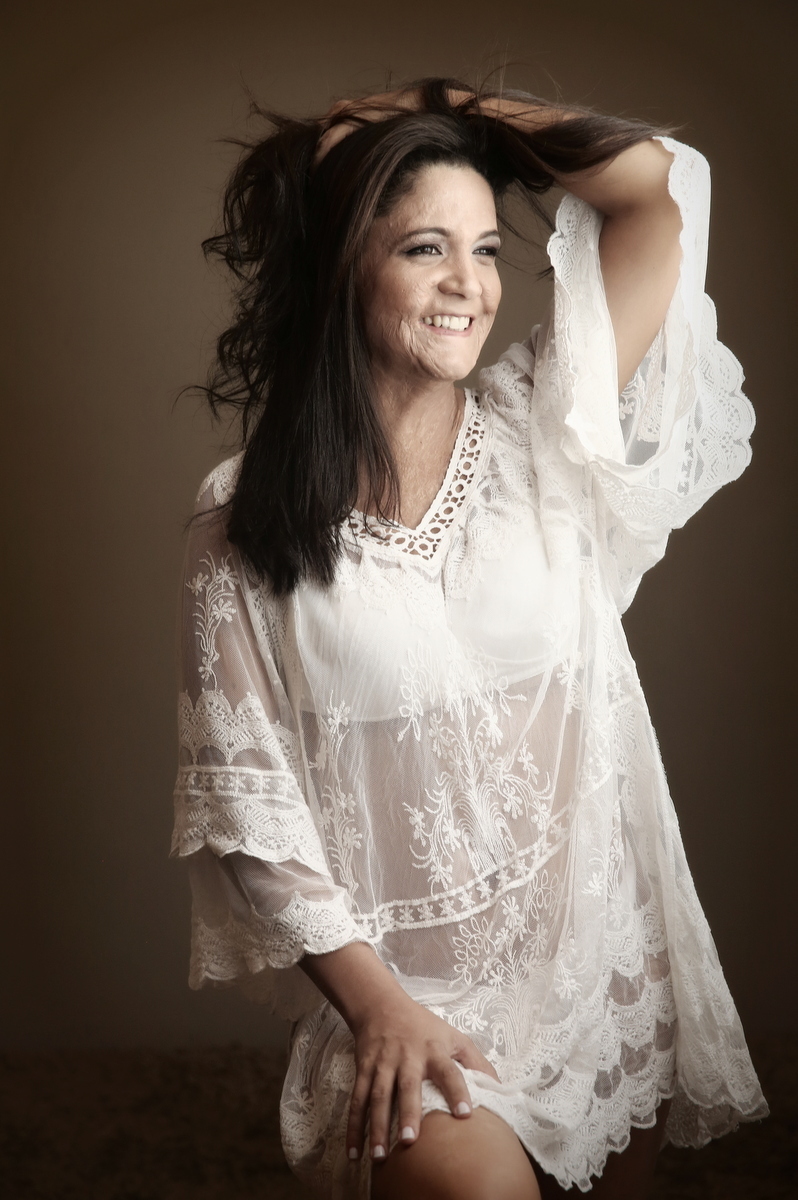 Ivna sá, ivna sá para mulheres, mulher queimada, ensaio feminino em belo horizonte, palestra para mulheres, queimadura, ivna sá fotografia, estúdio em belo horizonte 