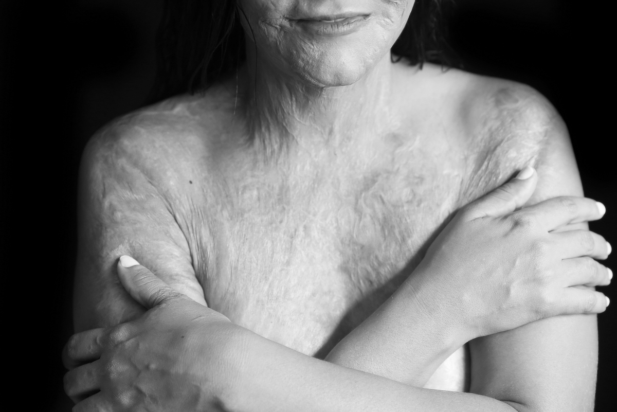 Ivna sá, ivna sá para mulheres, mulher queimada, ensaio feminino em belo horizonte, palestra para mulheres, queimadura, ivna sá fotografia, estúdio em belo horizonte 