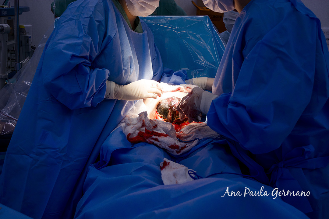 Fotografia de Parto - Maternidade Pro Matre Paulista - Nascimento do Bernardo | 17