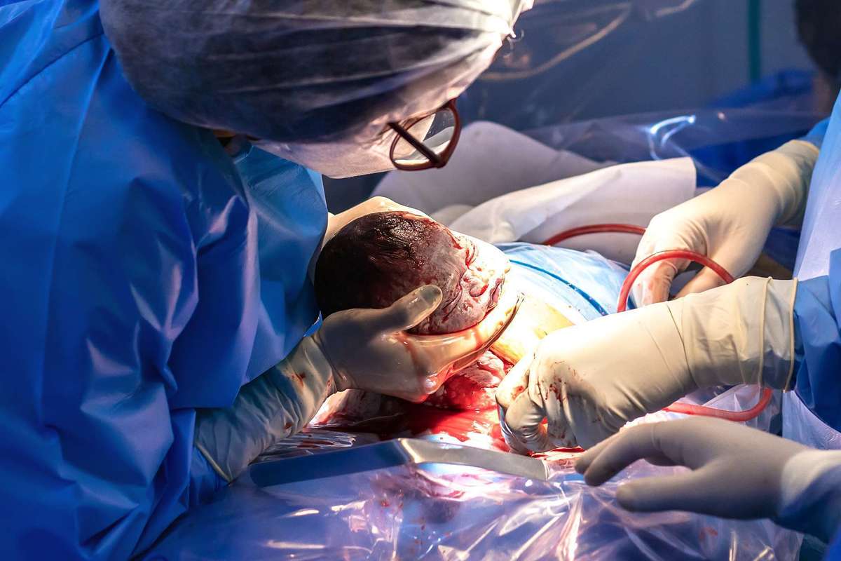 Fotografia de parto cesárea na Unimed Volta Redonda: Nascimento da Laura.