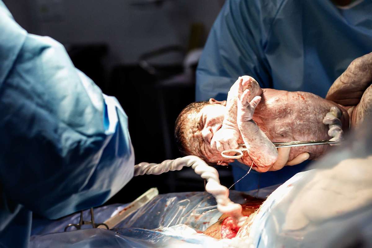 Fotografia de parto cesárea na Unimed Volta Redonda: Nascimento da Lyvía.