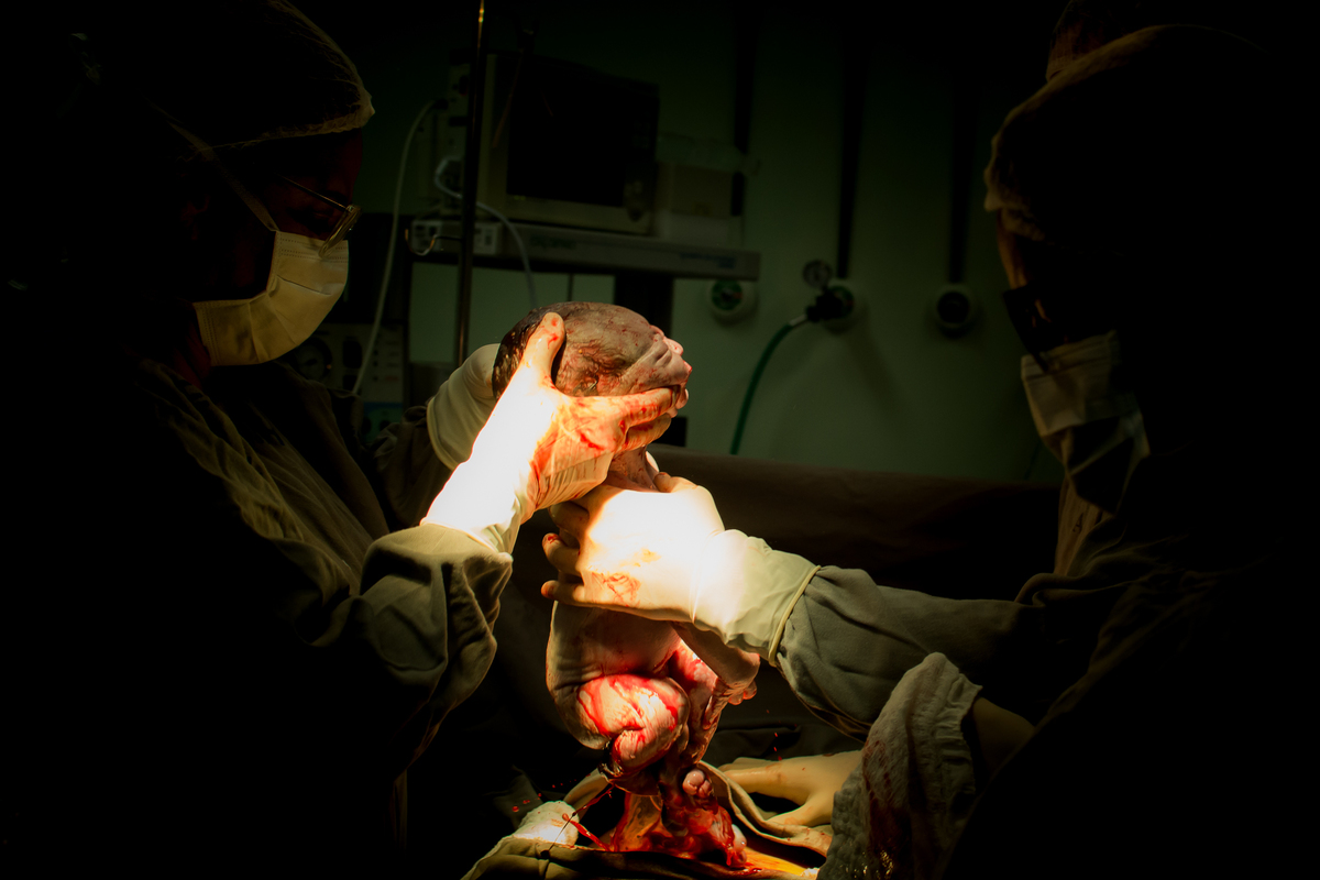 Fotografia de parto cesárea no Hinja Volta Redonda: Nascimento do Gabriel.