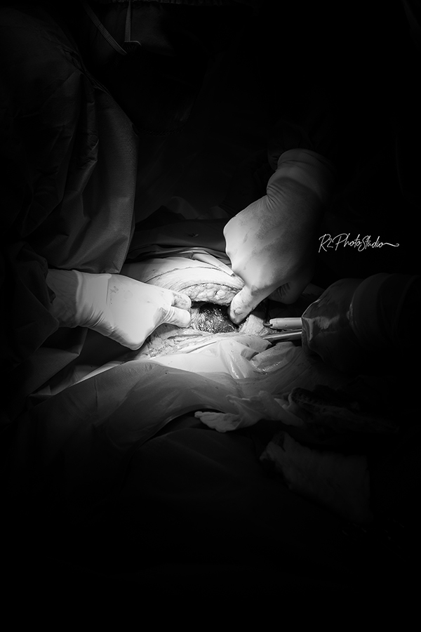 Foto do Bebe coroando na cesárea