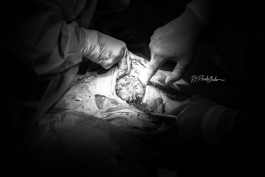 Foto do Bebe coroando na cesárea