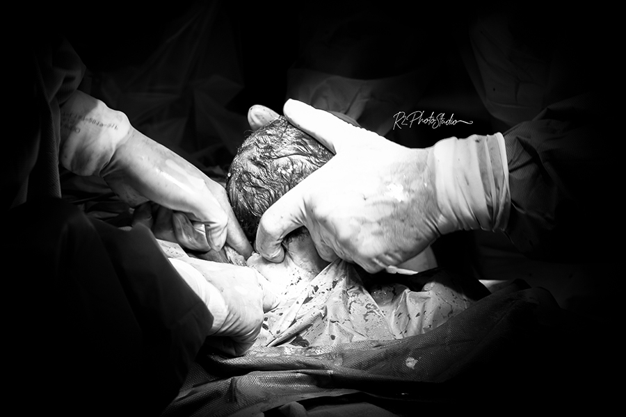 Foto do médico auxiliando a passagem da cabeça do bebe