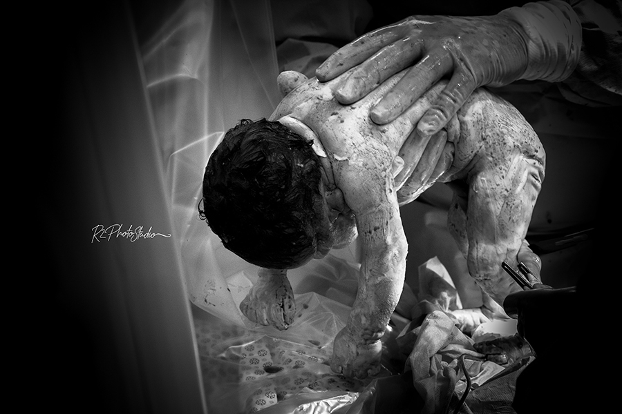 Foto do bebe sendo retirado da barriga