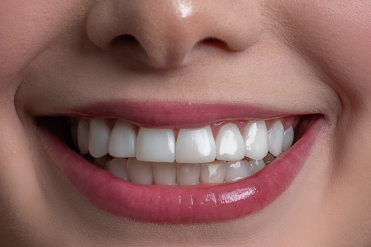 Imagem da transformação do sorriso com resina composta, sem desgastes dos dentes naturais. 