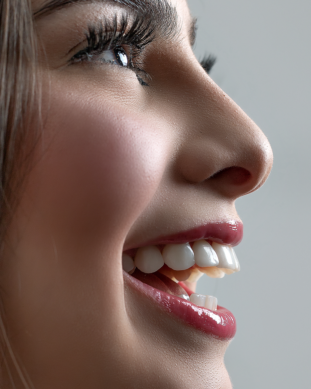 Imagem da transformação do sorriso com resina composta, sem desgastes dos dentes naturais. 