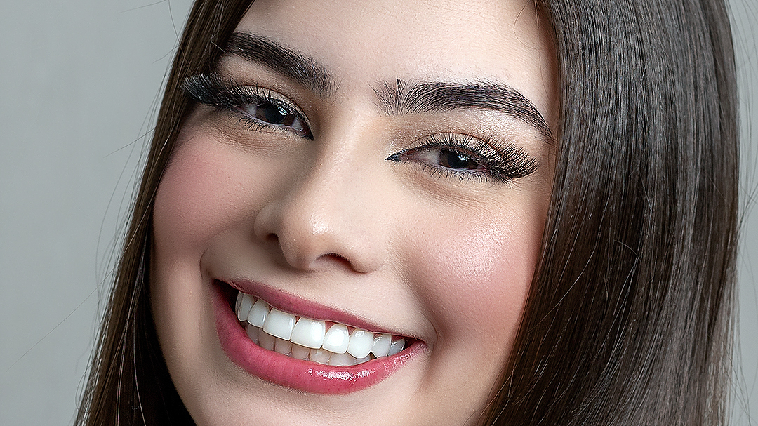 Imagem da transformação do sorriso com resina composta, sem desgastes dos dentes naturais. 